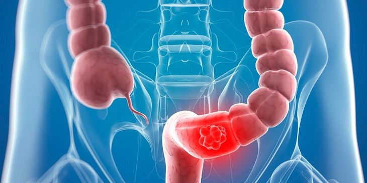 Khám sức khỏe định kỳ giúp phát hiện sớm nguy cơ ung thư tiêu hóa - Ảnh 2.