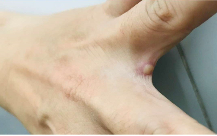Bệnh nhân đậu mùa khỉ đầu tiên ở TP.HCM hiện ra sao?