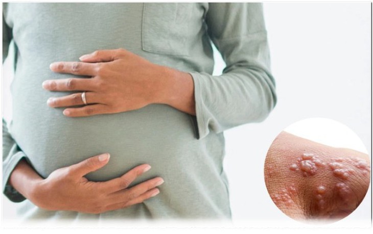 Các biện pháp phòng ngừa bệnh đậu mùa khỉ ở phụ nữ mang thai