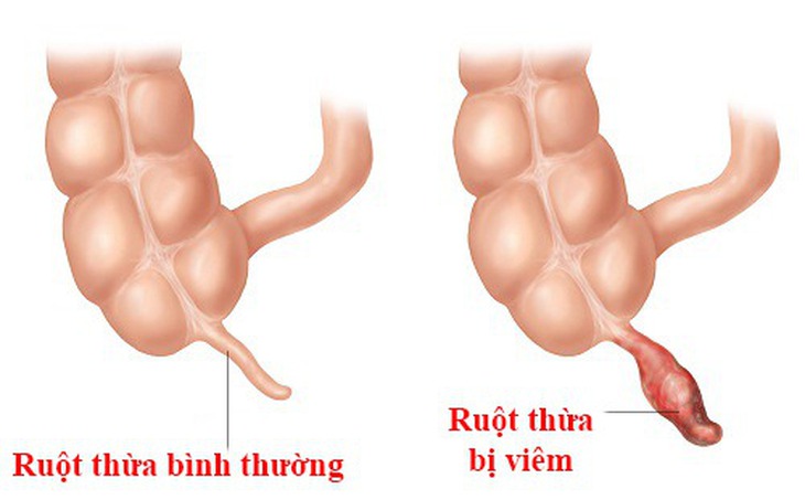 Nghĩ bị ngộ độc hải sản nhập viện bị viêm phúc mạc ruột thừa, dấu hiệu cảnh giác với căn bệnh này - Ảnh 1.