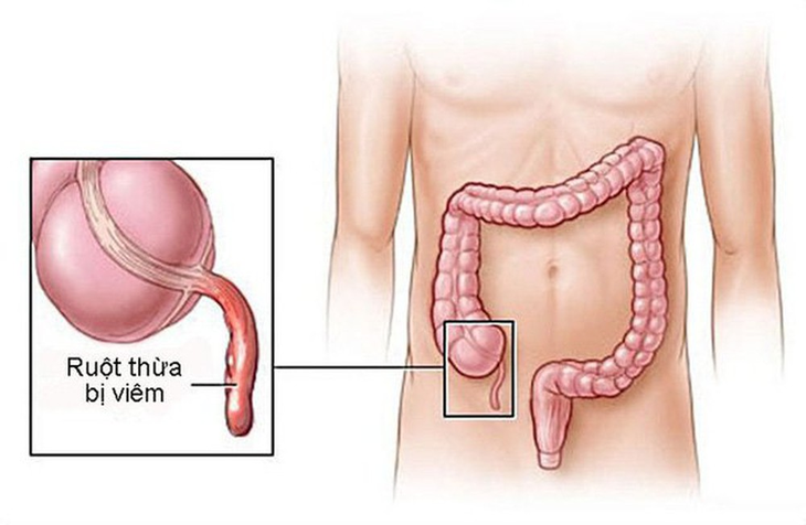 Viêm ruột thừa thường không có nguyên nhân rõ ràng. Bệnh thường xảy ra ở độ tuổi thanh thiếu niên và người trưởng thành .