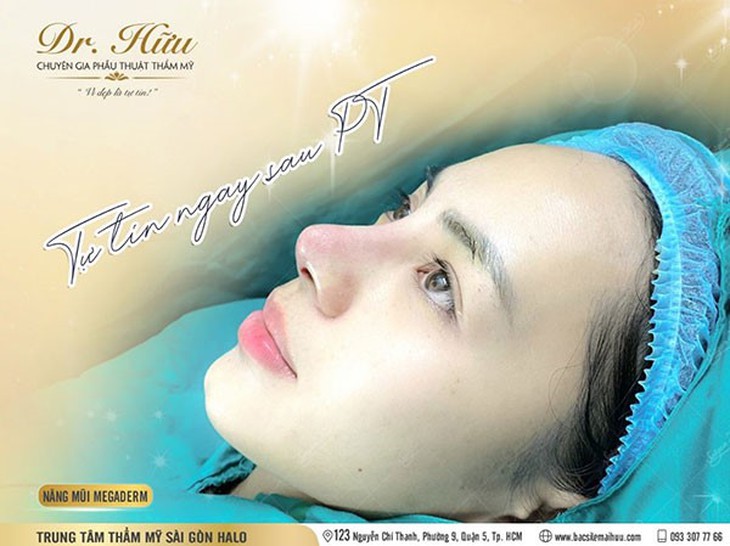 Nâng mũi đẹp tự nhiên bởi bác sĩ thẩm mỹ Lê Mai Hữu - Ảnh 4.