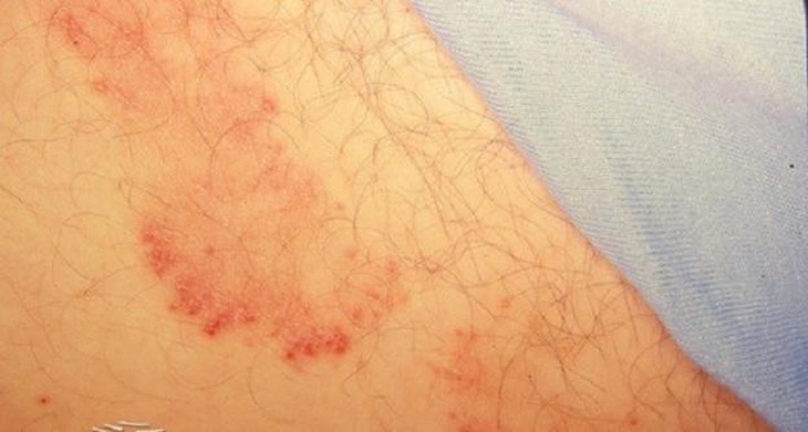 Nhiễm nấm vùng bẹn cần xử trí thế nào để hạn chế tái phát - Ảnh 1.