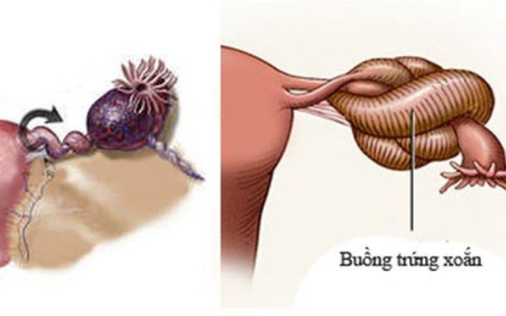 Giải đáp thắc mắc: U nang buồng trứng có nguy hiểm không?