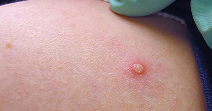Đậu mùa khỉ không dễ lây lan như COVID-19 hay bệnh cúm