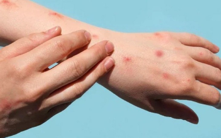 Đậu mùa khỉ có phải là bệnh lây truyền qua đường tình dục?