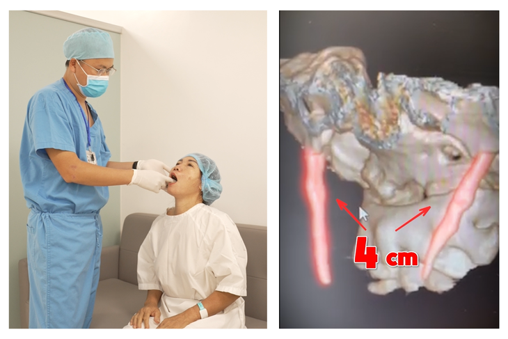 Hy hữu: Phẫu thuật thành công xương mỏm trâm dài 4cm, nữ bệnh nhân 60 tuổi thoát khỏi đau đớn - Ảnh 1.