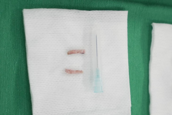Hy hữu: Phẫu thuật thành công xương mỏm trâm dài 4cm, nữ bệnh nhân 60 tuổi thoát khỏi đau đớn - Ảnh 3.
