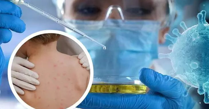 Cảnh báo nguy cơ xuất hiện thêm ca đậu mùa khỉ xâm nhập Việt Nam