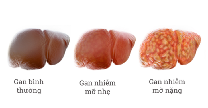 Ai có nguy cơ bị gan nhiễm mỡ?- Ảnh 1. Ai có nguy cơ bị gan nhiễm mỡ?- Ảnh 1.