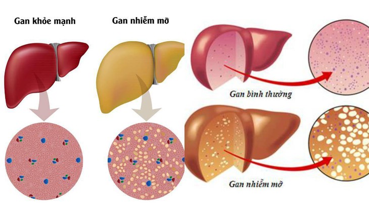 Gan nhiễm mỡ có mấy loại, cần phân biệt như thế nào? - Ảnh 1.
