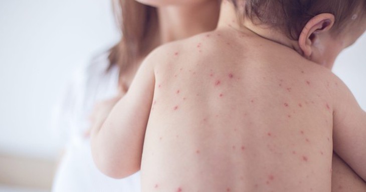 Sốt xuất huyết ở trẻ em: Trẻ nào dễ trở nặng?