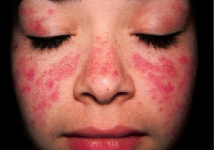 Dùng đơn thuốc cũ chữa lupus ban đỏ, nữ bệnh nhân phải nhập viện cấp cứu - Ảnh 1. Dùng đơn thuốc cũ chữa lupus ban đỏ, nữ bệnh nhân phải nhập viện cấp cứu - Ảnh 1.