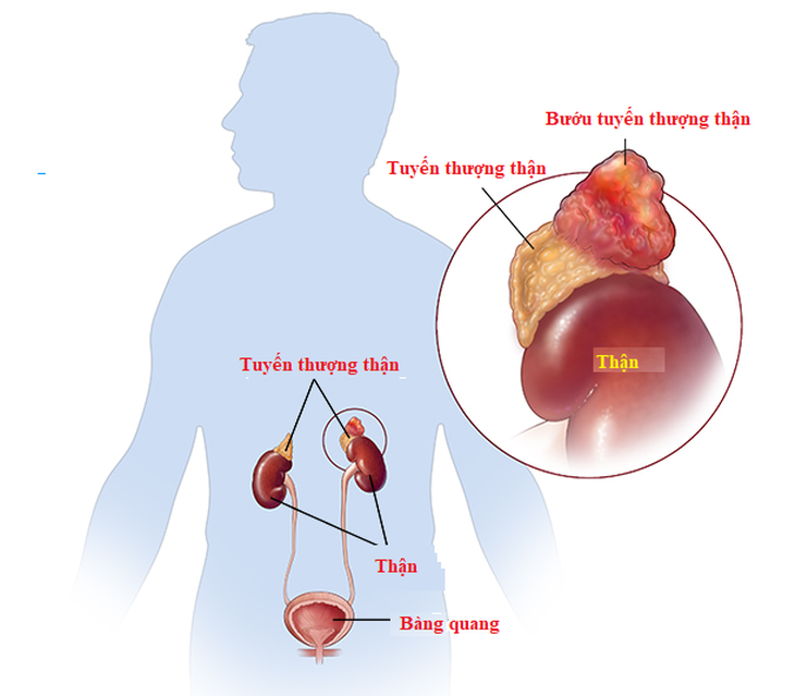 Phẫu thuật thành công cho người có hai khối bướu tuyến thượng thận lớn và hiếm gặp - Ảnh 3.