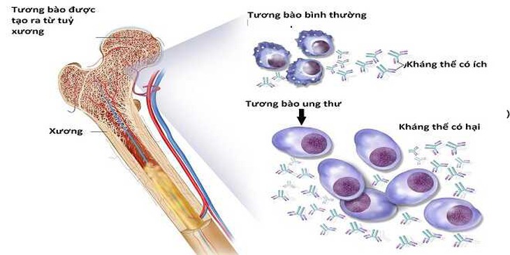 FDA cấp cho elranatamab điều trị đa u tủy xương tái phát khó chữa - Ảnh 2.