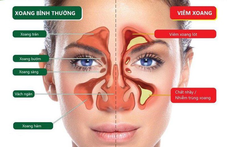 Các loại viêm xoang thường gặp và triệu chứng- Ảnh 1. Các loại viêm xoang thường gặp và triệu chứng- Ảnh 1.