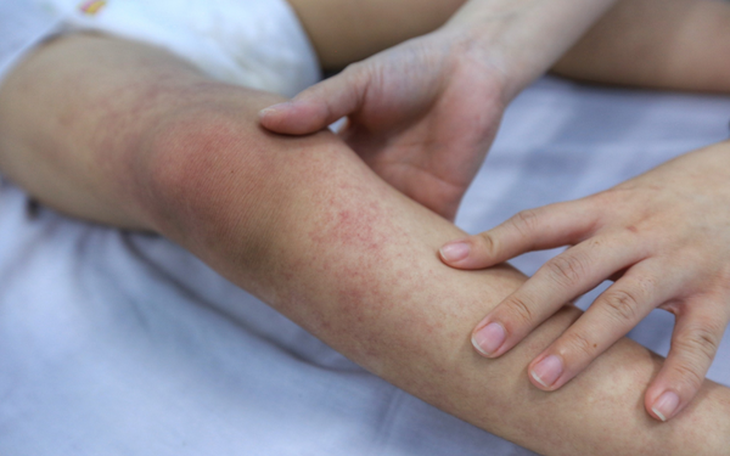 Sốt xuất huyết - dấu hiệu nhận biết và cách cắt sốt nhanh