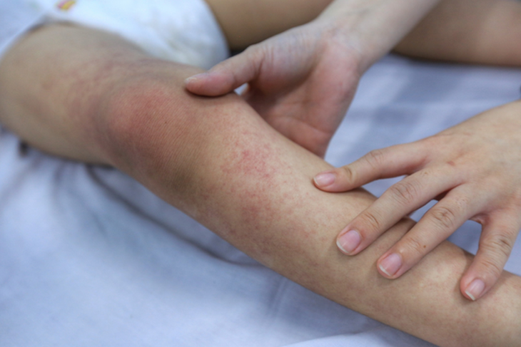 Sốt xuất huyết - dấu hiệu nhận biết và cách cắt sốt nhanh - Ảnh 1.