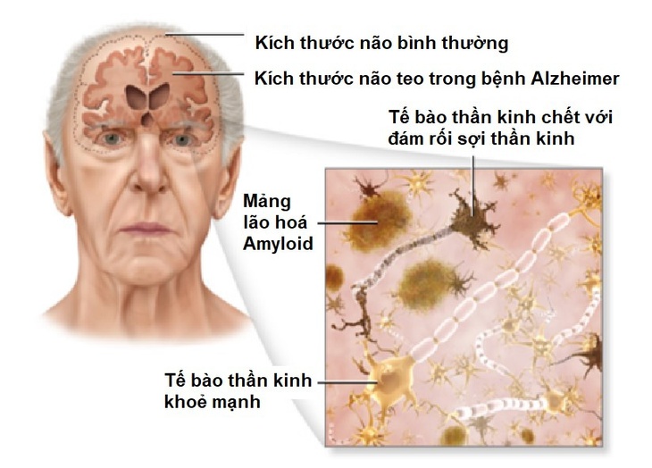 Kích hoạt gen có phải là liệu pháp điều trị bệnh Alzheimer trong tương lai? - Ảnh 1. Kích hoạt gen có phải là liệu pháp điều trị bệnh Alzheimer trong tương lai? - Ảnh 1.