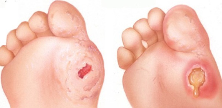 4 nguyên tắc để phòng ngừa loét bàn chân ở người đái tháo đường - Ảnh 2.