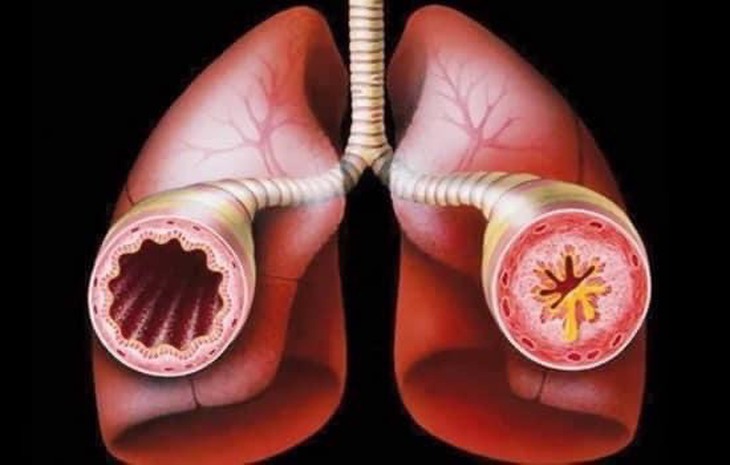 Khí dung salbutamol nhiều có sao không? - Ảnh 1.