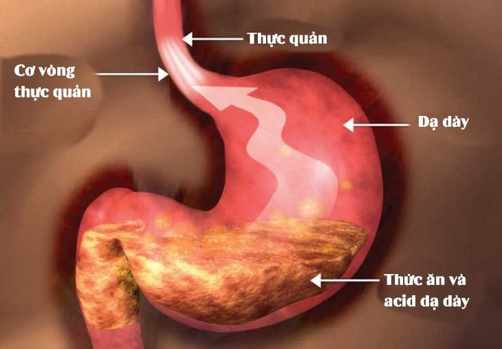 Nên điều trị trào ngược dạ dày thực quản vào thời điểm nào? - Ảnh 2.
