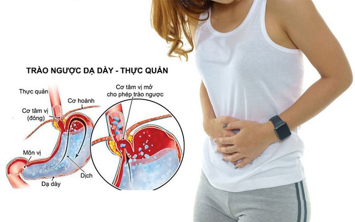 Điều trị trào ngược dạ dày thực quản và tiến bộ mới nhất - Ảnh 1. Điều trị trào ngược dạ dày thực quản và tiến bộ mới nhất - Ảnh 1.
