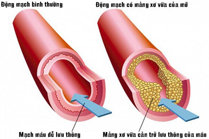 Thực đơn 'vàng' cho người bệnh máu nhiễm mỡ - Ảnh 2.