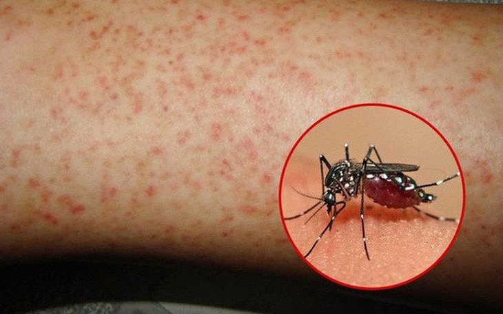 Giải pháp hỗ trợ tăng sức đề kháng cho người mắc sốt xuất huyết bằng liệu pháp tự nhiên - Ảnh 1.