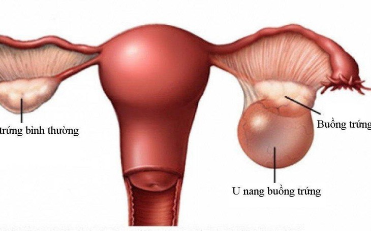 Chuyên gia cảnh báo phụ nữ mang thai không nên chủ quan với u buồng trứng