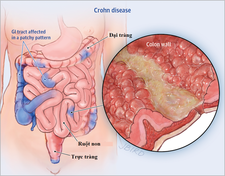 Mục tiêu mới trong điều trị bệnh Crohn - Ảnh 1.