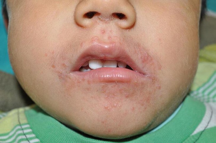 Biểu hiện bệnh trứng cá đỏ ở trẻ em và cách điều trị - Ảnh 4.