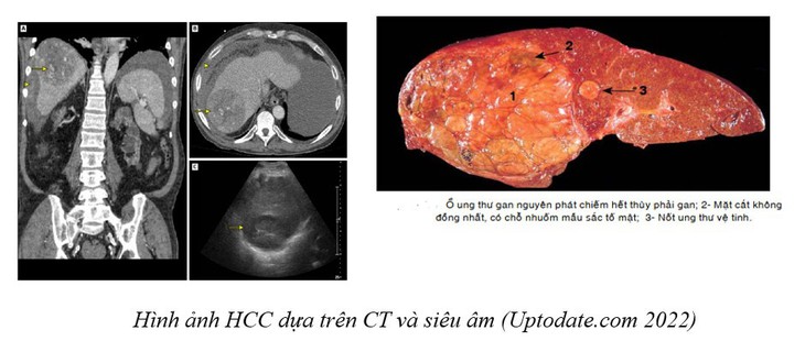 Điều trị và dự phòng ung thư biểu mô tế bào gan - Ảnh 1.