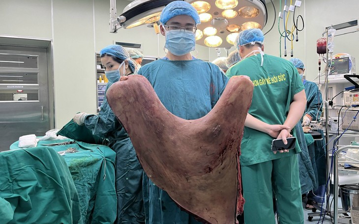 Cắt bỏ u sợi thần kinh 9kg hiếm gặp che hết lưng nam thanh niên