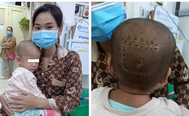 Phẫu thuật lấy khối u màng não cứu sống bệnh nhi 30 tháng tuổi - Ảnh 1.