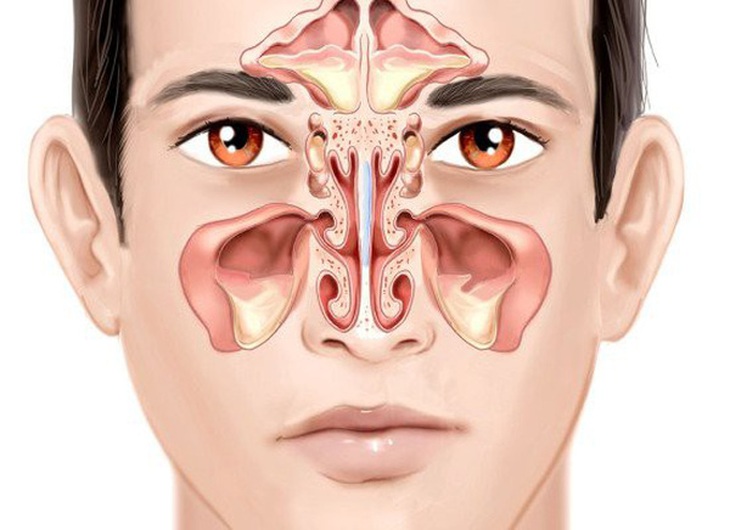 Viêm xoang là một trong những bệnh nhiễm trùng phổ biến.