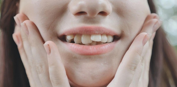 Răng mọc không đều, lệch lạc phải làm sao? - Ảnh 1.