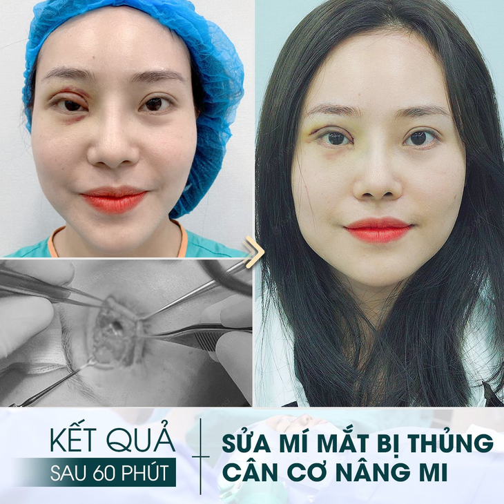 Cắt mí hỏng tại thẩm mỹ "chui", một phụ nữ gần như bị hỏng 1 mắt - Ảnh 2.