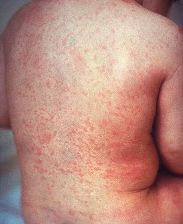 Rubella căn bệnh chưa có thuốc điều trị đặc hiệu được phát hiện như thế nào? - Ảnh 1.