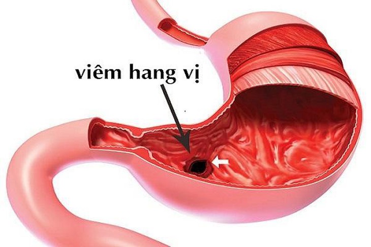 Viêm - loét hang vị dạ dày hỗ trợ bằng thảo dược được không?