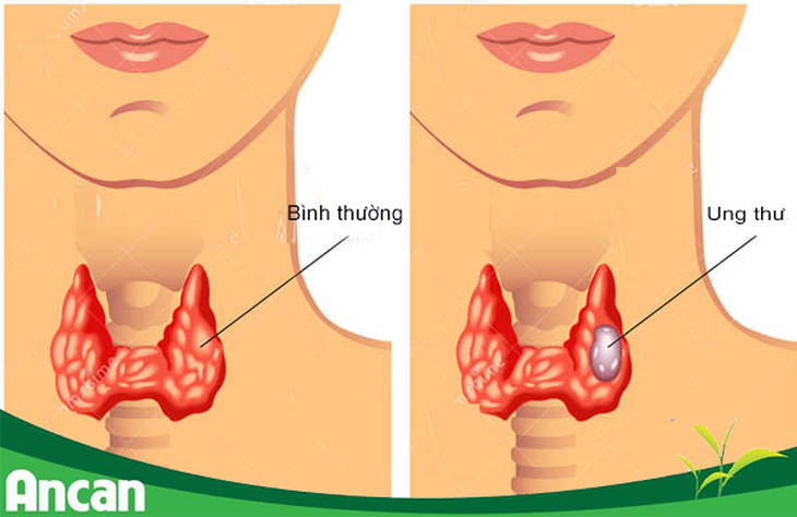 Phương pháp điều trị ung thư tuyến giáp- Ảnh 1. Phương pháp điều trị ung thư tuyến giáp- Ảnh 1.