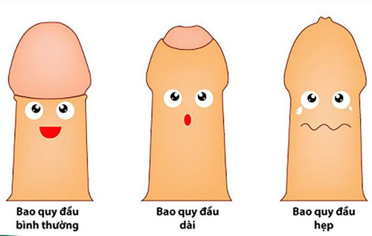 Cắt bao quy đầu phòng ung thư dương vật và lời khuyên của bác sĩ nam khoa - Ảnh 2. Cắt bao quy đầu phòng ung thư dương vật và lời khuyên của bác sĩ nam khoa - Ảnh 2.