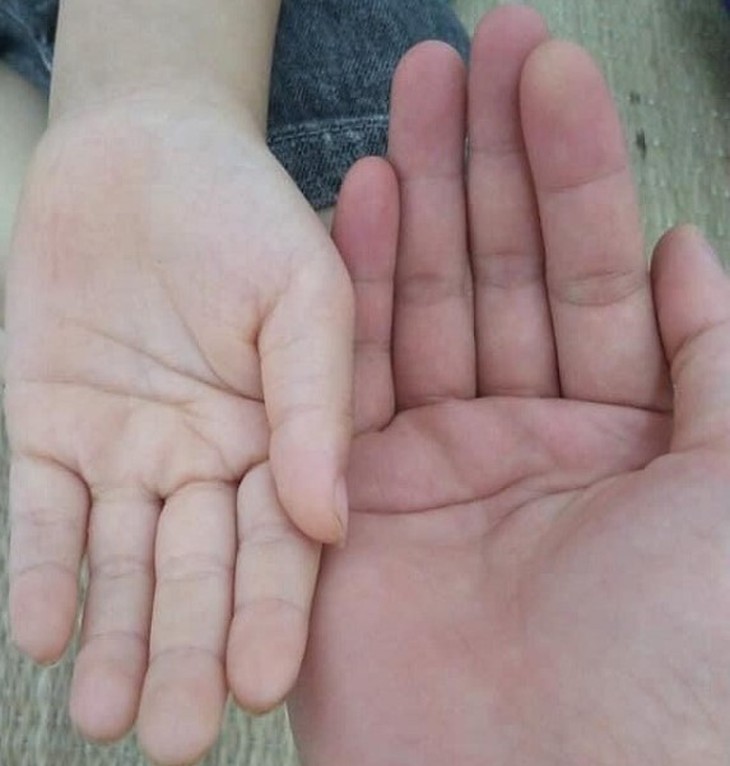 Đừng chủ quan: Trẻ cũng xuất huyết tiêu hóa - Ảnh 2. Đừng chủ quan: Trẻ cũng xuất huyết tiêu hóa - Ảnh 2.