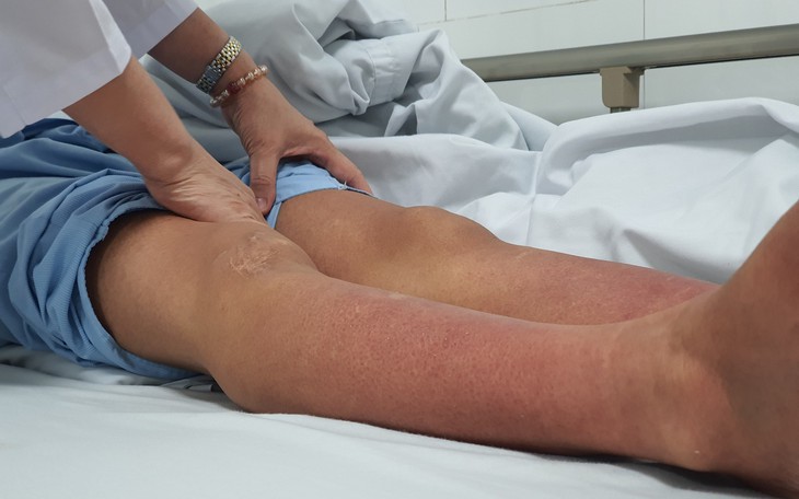 Sốt xuất huyết vào cao điểm, không tự điều trị tại nhà