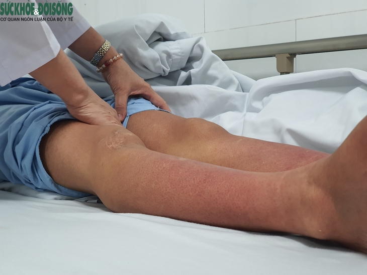 Sốt xuất huyết vào cao điểm, cảnh báo khi tự điều trị tại nhà - Ảnh 4. Sốt xuất huyết vào cao điểm, cảnh báo khi tự điều trị tại nhà - Ảnh 4.