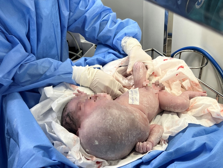 TP.HCM: Bé sơ sinh có khối bướu vùng mặt, cổ, ngực khủng nhất trong y văn thế giới - Ảnh 1. TP.HCM: Bé sơ sinh có khối bướu vùng mặt, cổ, ngực khủng nhất trong y văn thế giới - Ảnh 1.