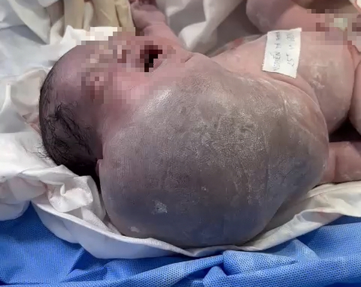 TP.HCM: Bé sơ sinh có khối bướu vùng mặt, cổ, ngực khủng nhất trong y văn thế giới - Ảnh 2. TP.HCM: Bé sơ sinh có khối bướu vùng mặt, cổ, ngực khủng nhất trong y văn thế giới - Ảnh 2.