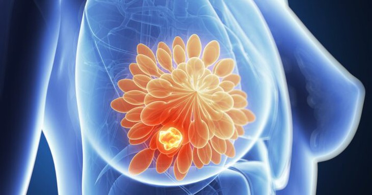 Vaccine ung thư vú vượt qua thử nghiệm trên người giai đoạn 1 - Ảnh 3.