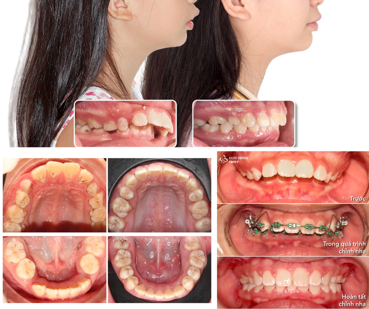 Phương pháp niềng răng cho trẻ em nhẹ nhàng, ít đau - Ảnh 1.