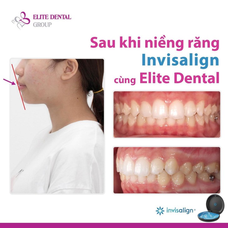 Phương pháp niềng răng cho trẻ em nhẹ nhàng, ít đau - Ảnh 3.